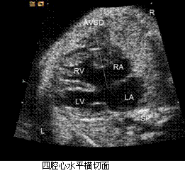 根据上述声像改变，比较合适的诊断有