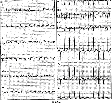 患者发生的心律失常类型是