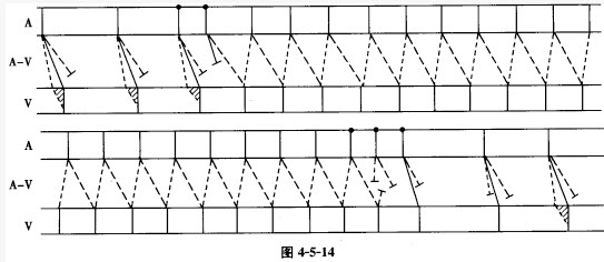 心动过速发作前后的梯形图符号表示还存在