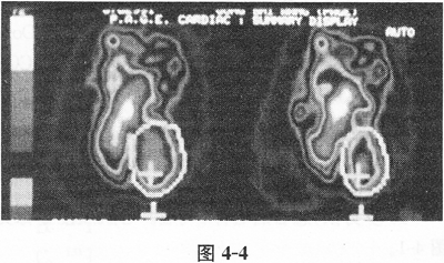 根据图像所示，此患者室壁运动类型属于