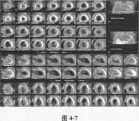 扩张型心肌病有效诊断方法有