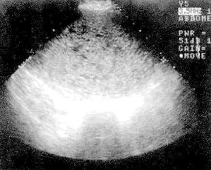 该患者超声检查结果为：子宫明显增大，14.7cm×10.8c