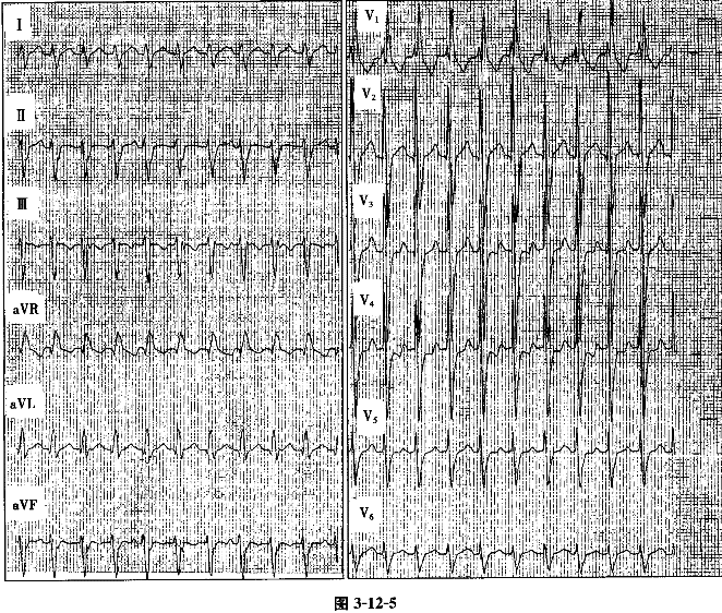 根据该心电图特征可初步诊断为