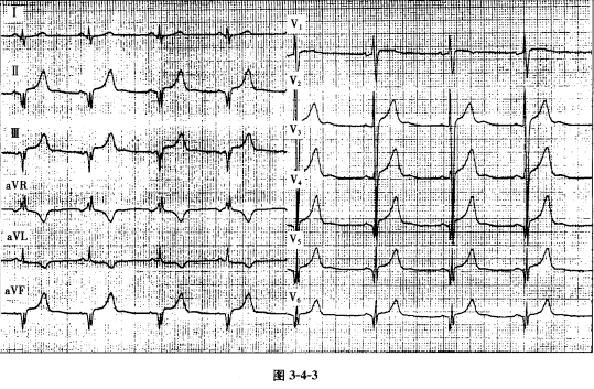 该患者的心电图表现酷似