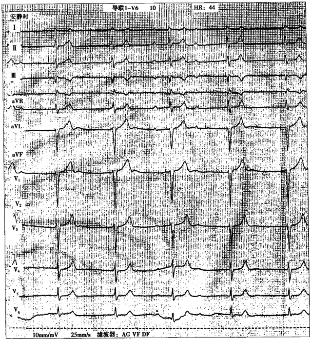心电图诊断应为