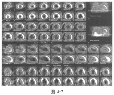 提问2：根据心肌灌注显像图，最可能的诊断是